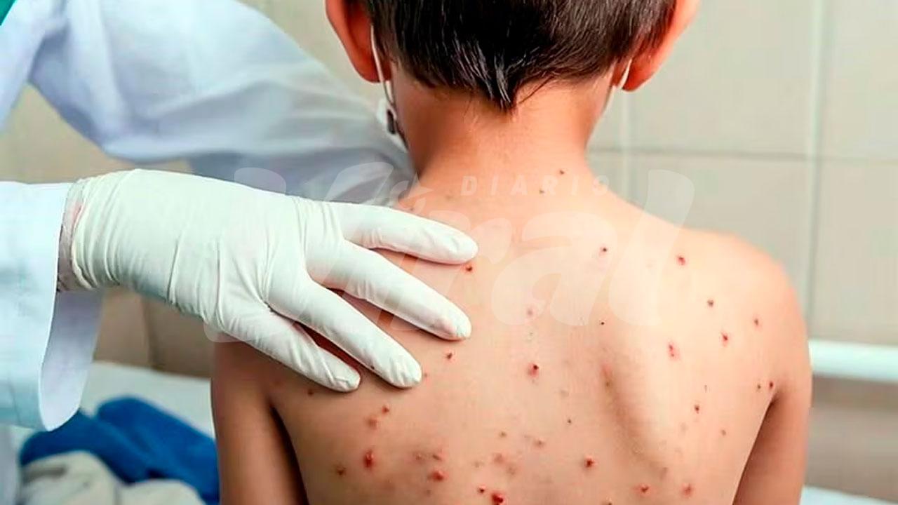Arequipa reduce casos de sarampión, pero 60 % de niños sigue sin vacunarse