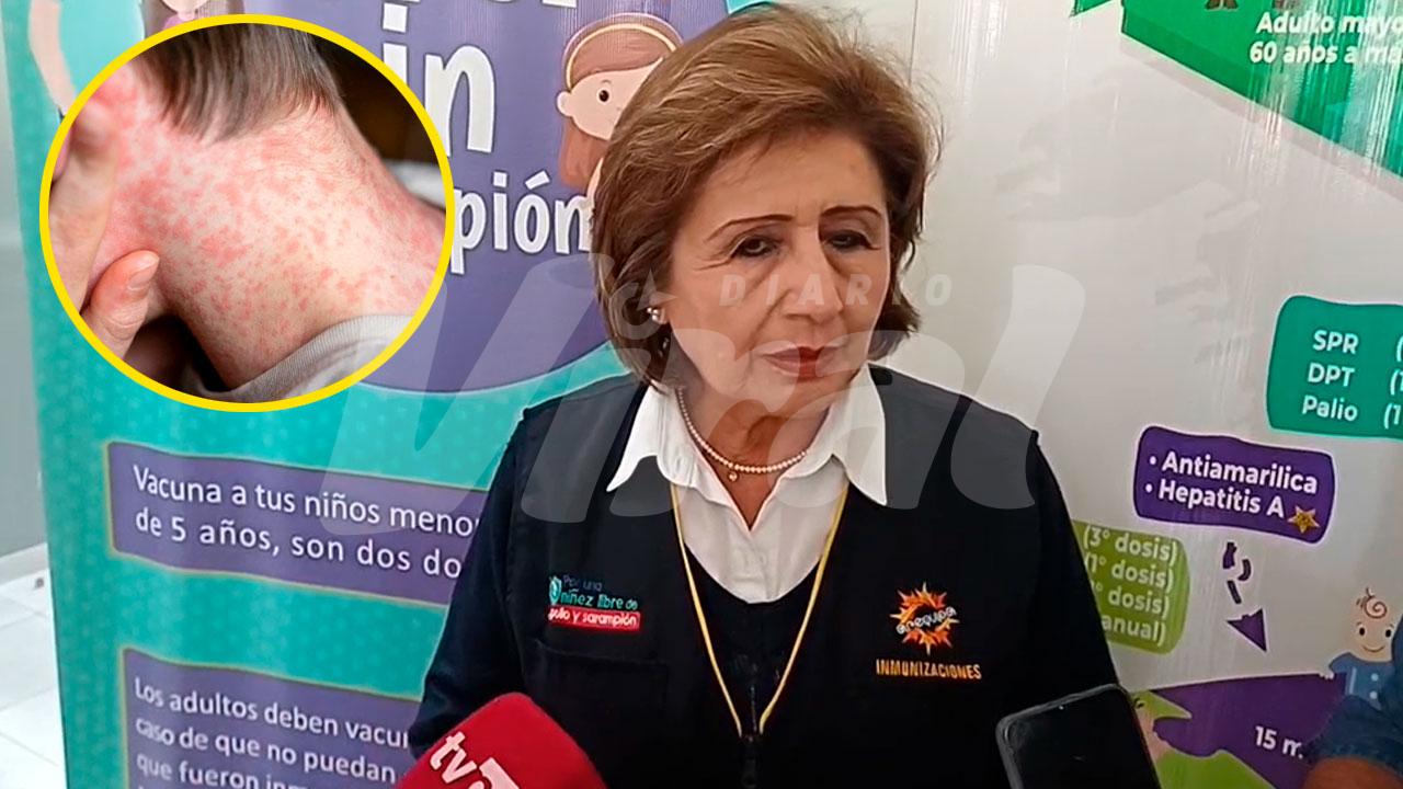 Arequipa registra 157 casos de sarampión y Secocha concentra el mayor brote 