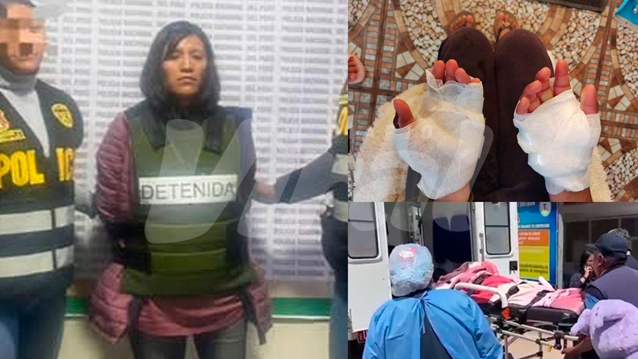 Niña evacuada a Arequipa con 40% del cuerpo quemado